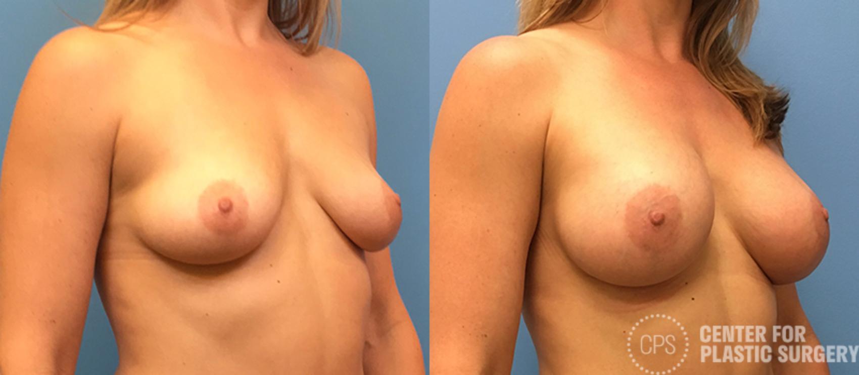 Breast Augmentation with Lift Case 122 Before & After Right Oblique | Annandale, Washington D.C. Metropolitan Area | Center for Plastic Surgery