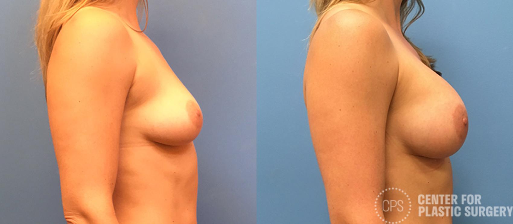 Breast Augmentation with Lift Case 122 Before & After Right Side | Annandale, Washington D.C. Metropolitan Area | Center for Plastic Surgery