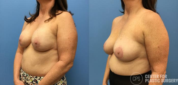 Breast Augmentation with Lift Case 148 Before & After Left Oblique | Chevy Chase & Annandale, Washington D.C. Metropolitan Area | Center for Plastic Surgery