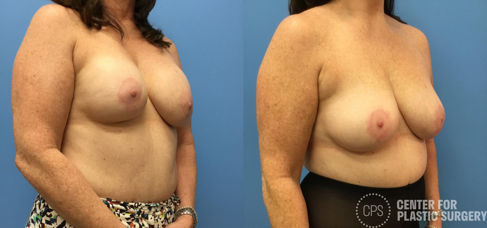 Breast Augmentation with Lift Case 148 Before & After Right Oblique | Annandale, Washington D.C. Metropolitan Area | Center for Plastic Surgery
