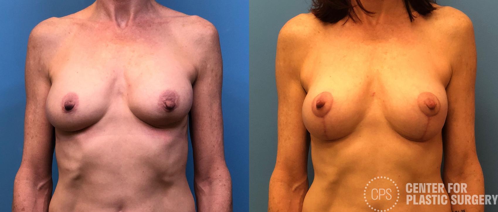 Breast Augmentation with Lift Case 177 Before & After Front | Chevy Chase & Annandale, Washington D.C. Metropolitan Area | Center for Plastic Surgery