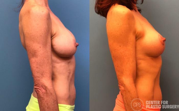 Breast Augmentation with Lift Case 177 Before & After Right Side | Chevy Chase & Annandale, Washington D.C. Metropolitan Area | Center for Plastic Surgery