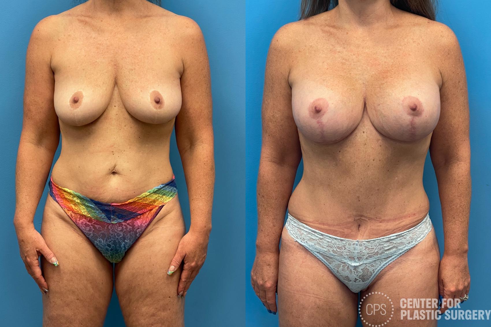 Breast Augmentation with Lift Case 216 Before & After Front | Annandale, Washington D.C. Metropolitan Area | Center for Plastic Surgery