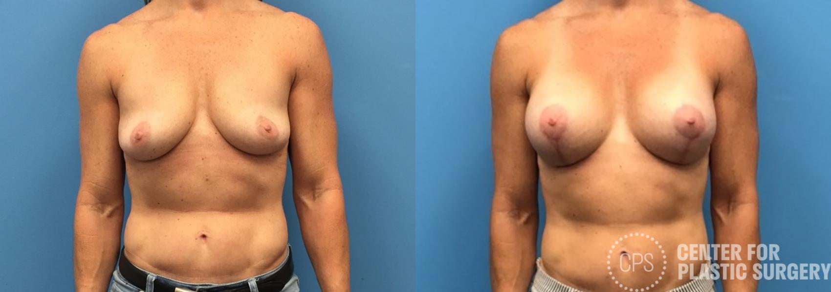 Breast Augmentation with Lift Case 230 Before & After Front | Chevy Chase & Annandale, Washington D.C. Metropolitan Area | Center for Plastic Surgery