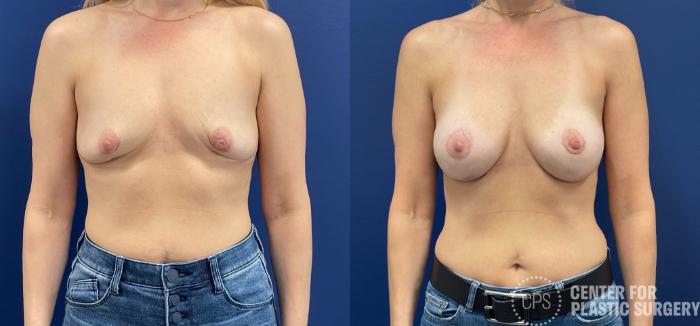 Breast Augmentation with Lift Case 231 Before & After Front | Chevy Chase & Annandale, Washington D.C. Metropolitan Area | Center for Plastic Surgery