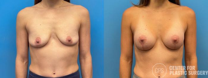 Breast Augmentation with Lift Case 232 Before & After Front | Chevy Chase & Annandale, Washington D.C. Metropolitan Area | Center for Plastic Surgery