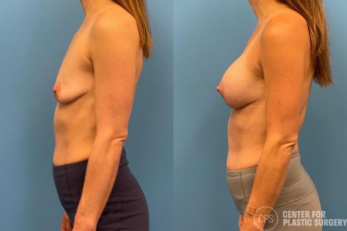 Breast Augmentation with Lift Case 232 Before & After Left Side | Chevy Chase & Annandale, Washington D.C. Metropolitan Area | Center for Plastic Surgery