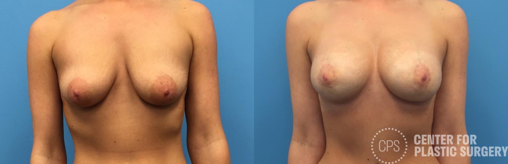 Breast Augmentation with Lift Case 233 Before & After Front | Washington, DC, Washington D.C. Metropolitan Area | Center for Plastic Surgery