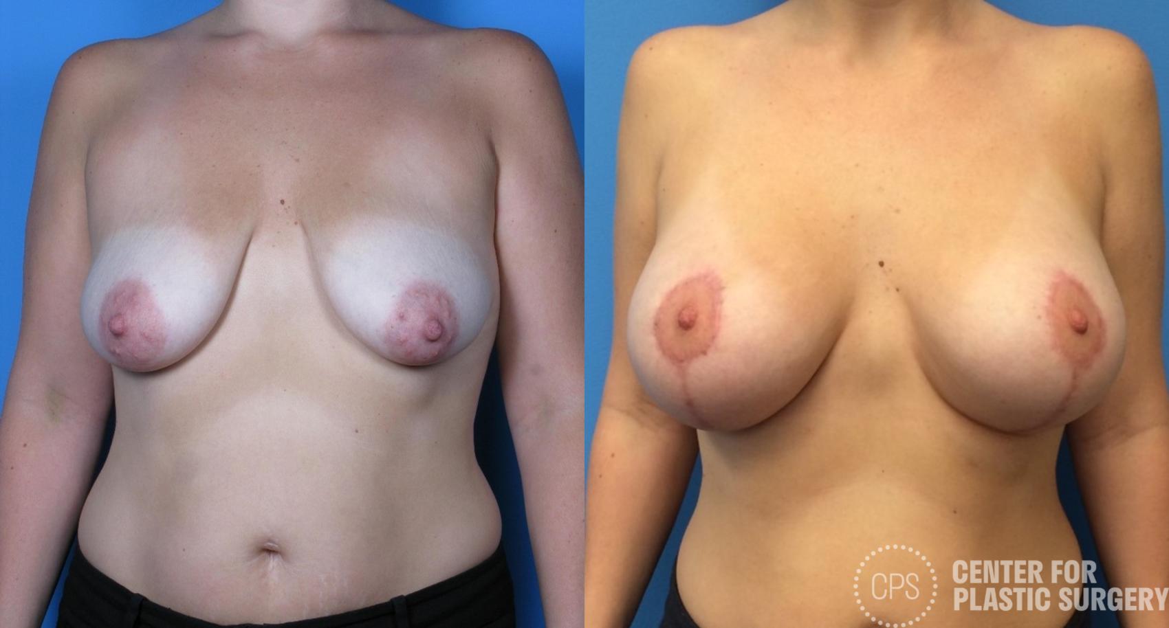 Breast Augmentation with Lift Case 234 Before & After Front | Chevy Chase & Annandale, Washington D.C. Metropolitan Area | Center for Plastic Surgery