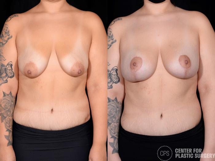 Breast Augmentation with Lift Case 351 Before & After Front | Chevy Chase & Annandale, Washington D.C. Metropolitan Area | Center for Plastic Surgery