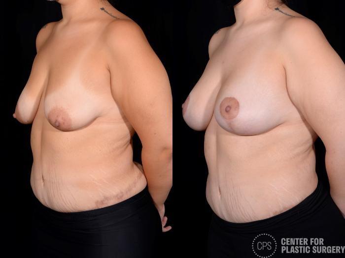 Breast Augmentation with Lift Case 351 Before & After Left Oblique | Chevy Chase & Annandale, Washington D.C. Metropolitan Area | Center for Plastic Surgery