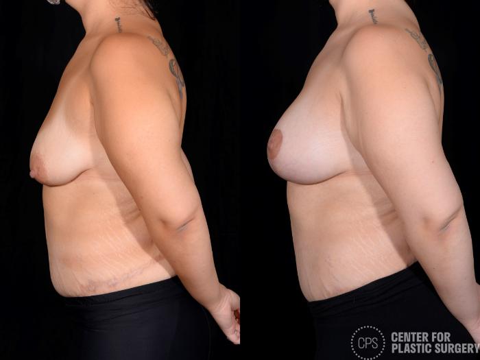 Breast Augmentation with Lift Case 351 Before & After Left Side | Chevy Chase & Annandale, Washington D.C. Metropolitan Area | Center for Plastic Surgery