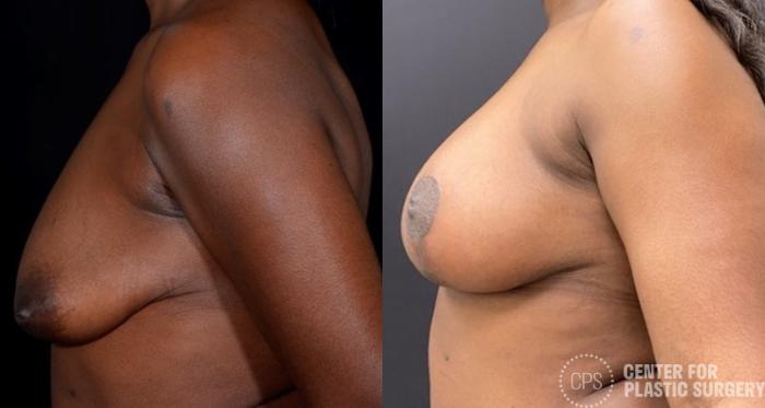 Breast Augmentation with Lift Case 385 Before & After Left Side | Chevy Chase & Annandale, Washington D.C. Metropolitan Area | Center for Plastic Surgery