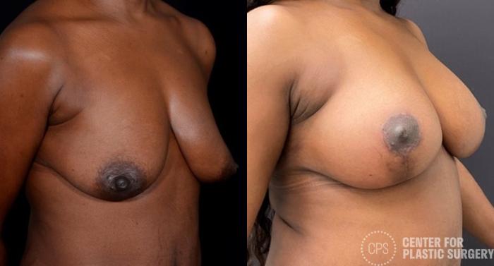 Breast Augmentation with Lift Case 385 Before & After Right Oblique | Chevy Chase & Annandale, Washington D.C. Metropolitan Area | Center for Plastic Surgery