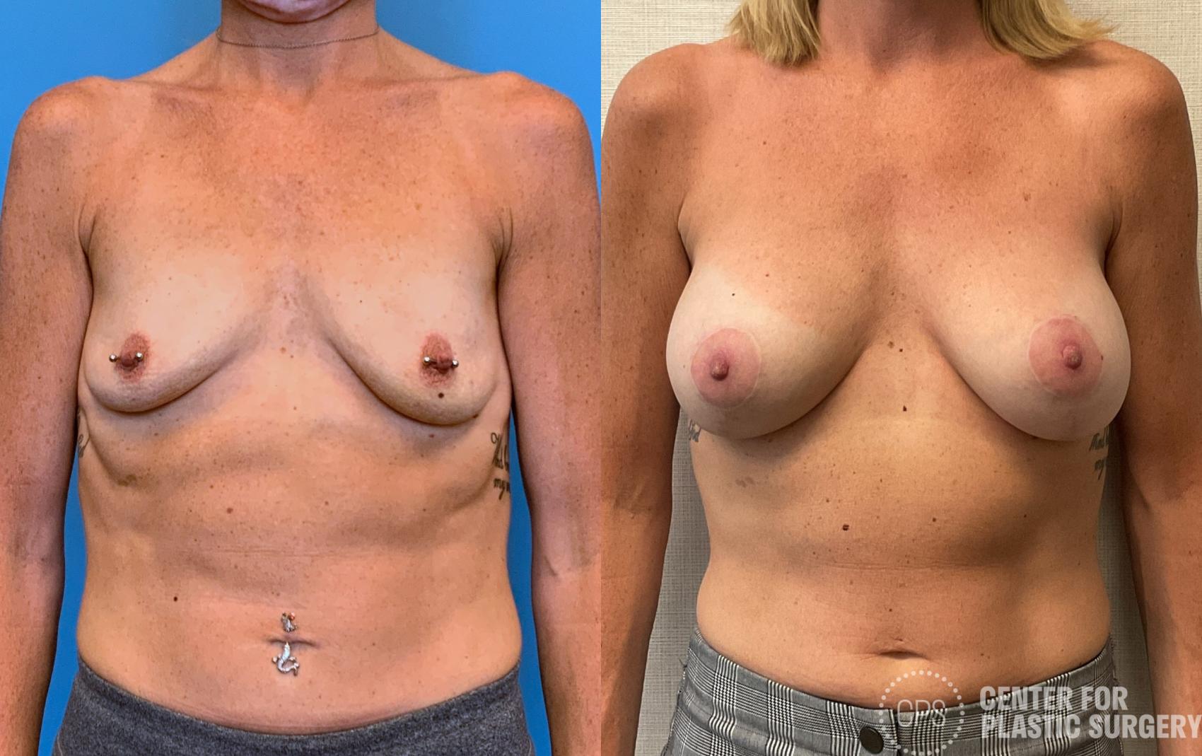 Breast Augmentation with Lift Case 403 Before & After Front | Chevy Chase & Annandale, Washington D.C. Metropolitan Area | Center for Plastic Surgery