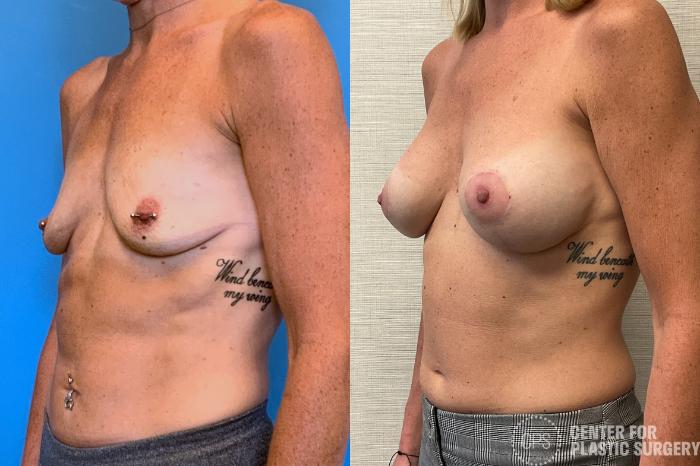 Breast Augmentation with Lift Case 403 Before & After Left Oblique | Chevy Chase & Annandale, Washington D.C. Metropolitan Area | Center for Plastic Surgery