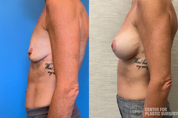 Breast Augmentation with Lift Case 403 Before & After Left Side | Chevy Chase & Annandale, Washington D.C. Metropolitan Area | Center for Plastic Surgery