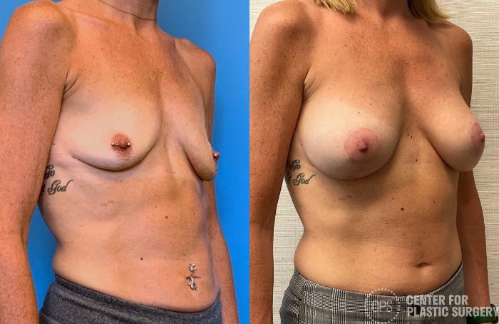 Breast Augmentation with Lift Case 403 Before & After Right Oblique | Chevy Chase & Annandale, Washington D.C. Metropolitan Area | Center for Plastic Surgery