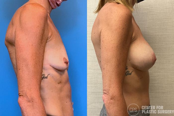 Breast Augmentation with Lift Case 403 Before & After Right Side | Chevy Chase & Annandale, Washington D.C. Metropolitan Area | Center for Plastic Surgery