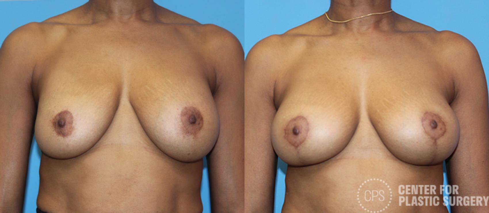 Breast Augmentation with Lift Case 99 Before & After Front | Chevy Chase & Annandale, Washington D.C. Metropolitan Area | Center for Plastic Surgery