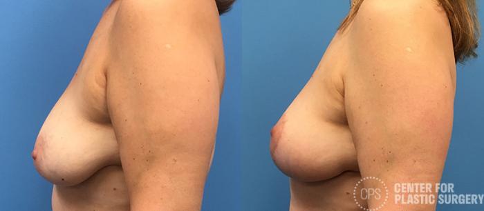 Breast Lift Case 124 Before & After Left Side | Chevy Chase & Annandale, Washington D.C. Metropolitan Area | Center for Plastic Surgery