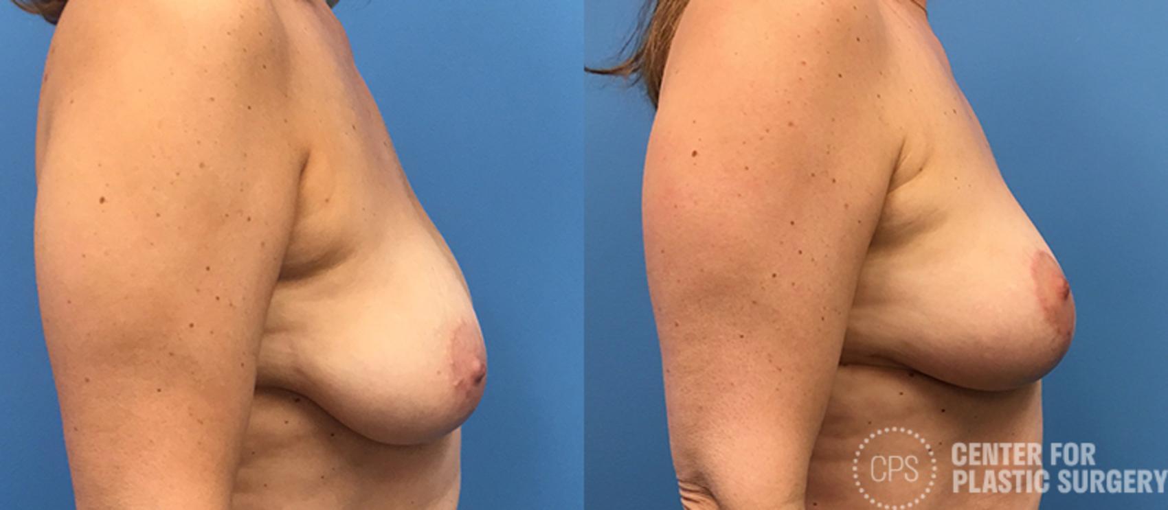 Breast Lift Case 124 Before & After Right Side | Annandale, Washington D.C. Metropolitan Area | Center for Plastic Surgery