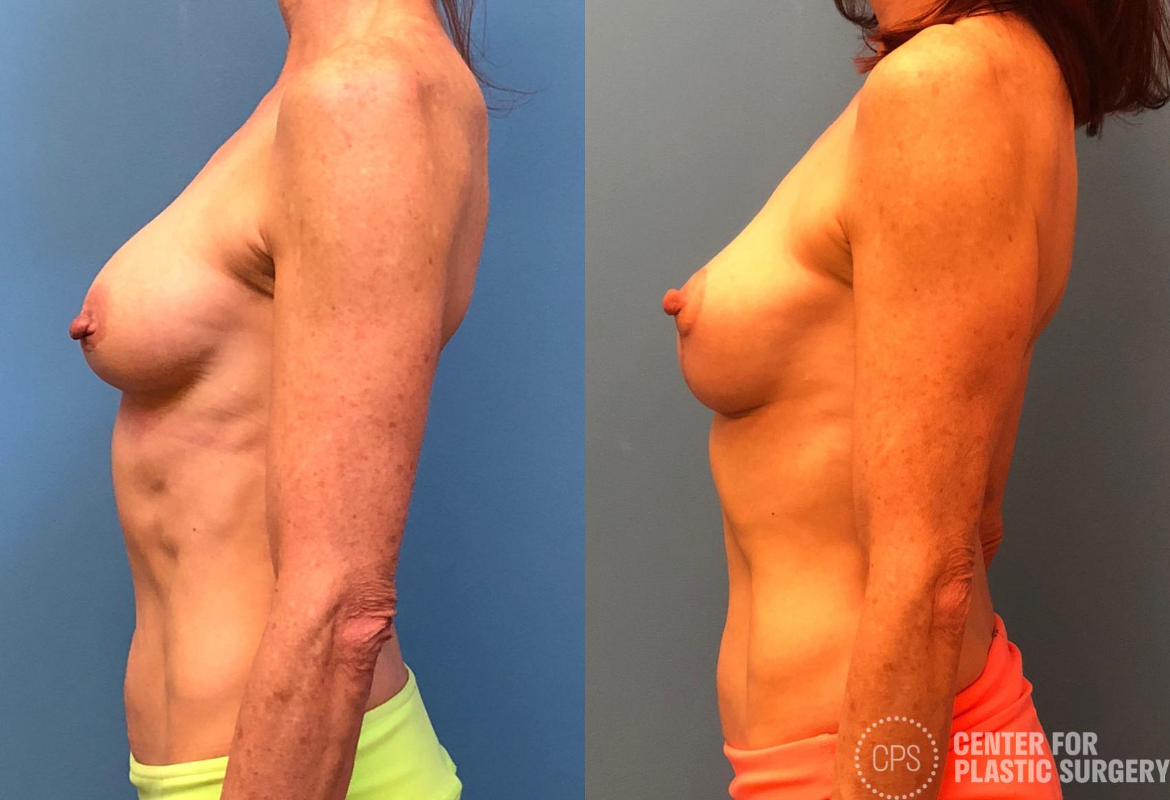 Breast Lift Case 177 Before & After Left Side | Annandale, Washington D.C. Metropolitan Area | Center for Plastic Surgery