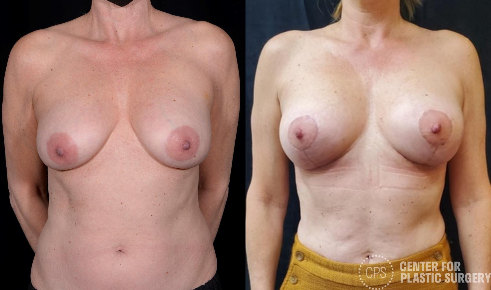 Breast Lift Case 370 Before & After Front | Washington, DC, Washington D.C. Metropolitan Area | Center for Plastic Surgery