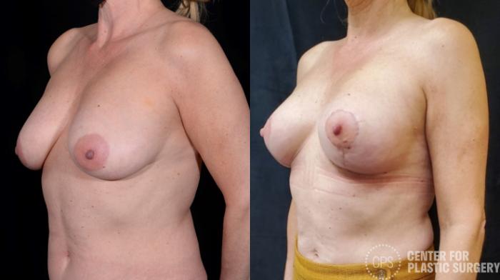 Breast Lift Case 370 Before & After Left Oblique | Chevy Chase & Annandale, Washington D.C. Metropolitan Area | Center for Plastic Surgery