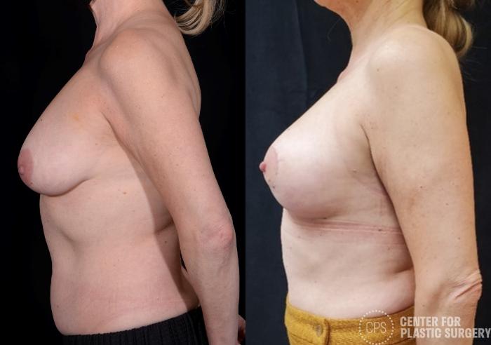 Breast Lift Case 370 Before & After Left Side | Chevy Chase & Annandale, Washington D.C. Metropolitan Area | Center for Plastic Surgery