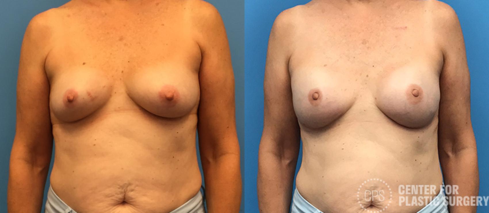 Breast Reconstruction Case 133 Before & After Front | Annandale, Washington D.C. Metropolitan Area | Center for Plastic Surgery