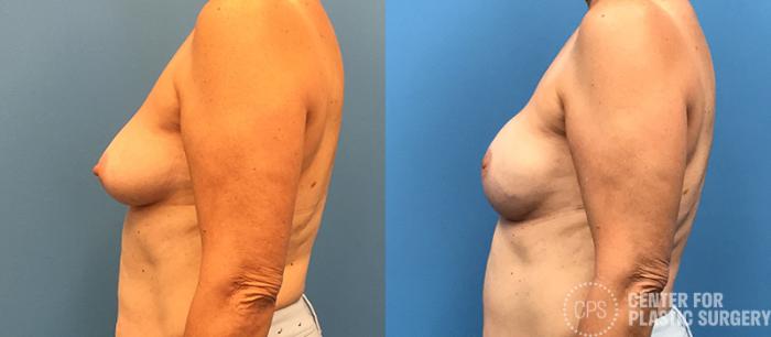 Breast Reconstruction Case 133 Before & After Left Side | Chevy Chase & Annandale, Washington D.C. Metropolitan Area | Center for Plastic Surgery