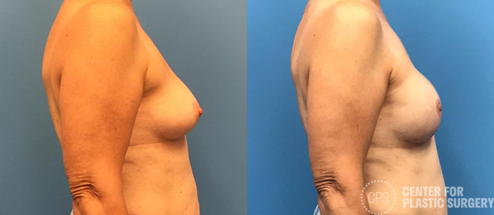 Breast Reconstruction Case 133 Before & After Right Side | Annandale, Washington D.C. Metropolitan Area | Center for Plastic Surgery