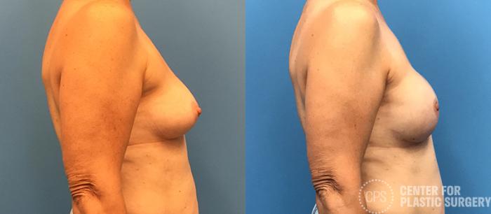 Breast Reconstruction Case 133 Before & After Right Side | Chevy Chase & Annandale, Washington D.C. Metropolitan Area | Center for Plastic Surgery