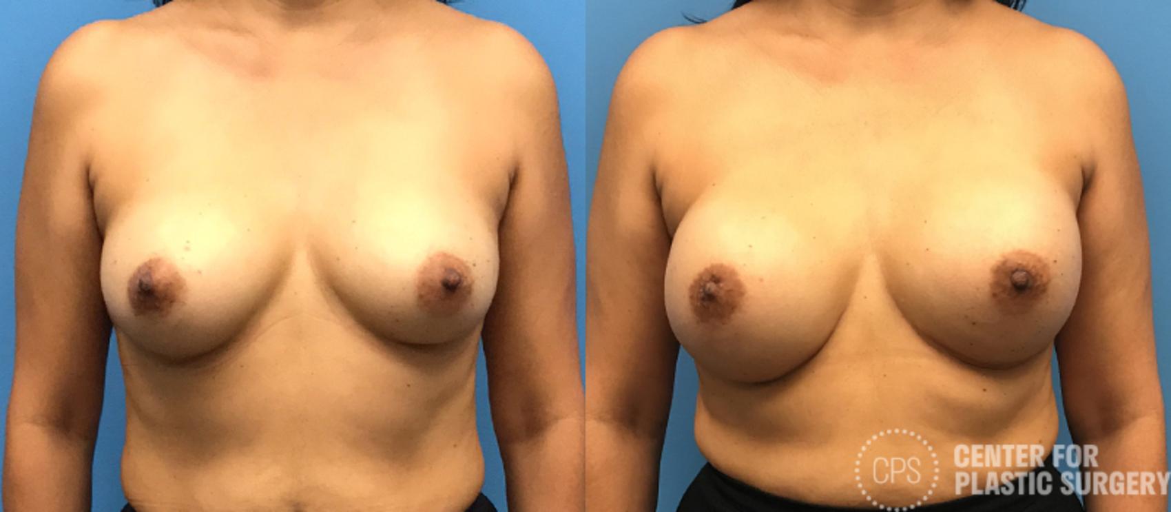 Breast Reconstruction Case 134 Before & After Front | Annandale, Washington D.C. Metropolitan Area | Center for Plastic Surgery