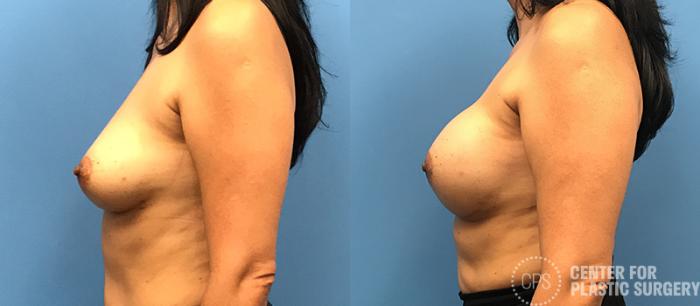 Breast Reconstruction Case 134 Before & After Left Side | Chevy Chase & Annandale, Washington D.C. Metropolitan Area | Center for Plastic Surgery