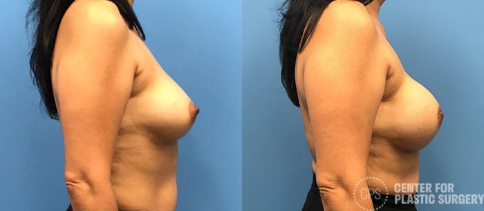 Breast Reconstruction Case 134 Before & After Right Side | Chevy Chase & Annandale, Washington D.C. Metropolitan Area | Center for Plastic Surgery