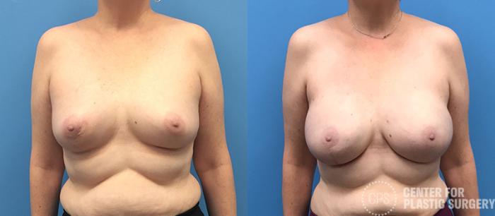 Breast Reconstruction Case 135 Before & After Front | Chevy Chase & Annandale, Washington D.C. Metropolitan Area | Center for Plastic Surgery