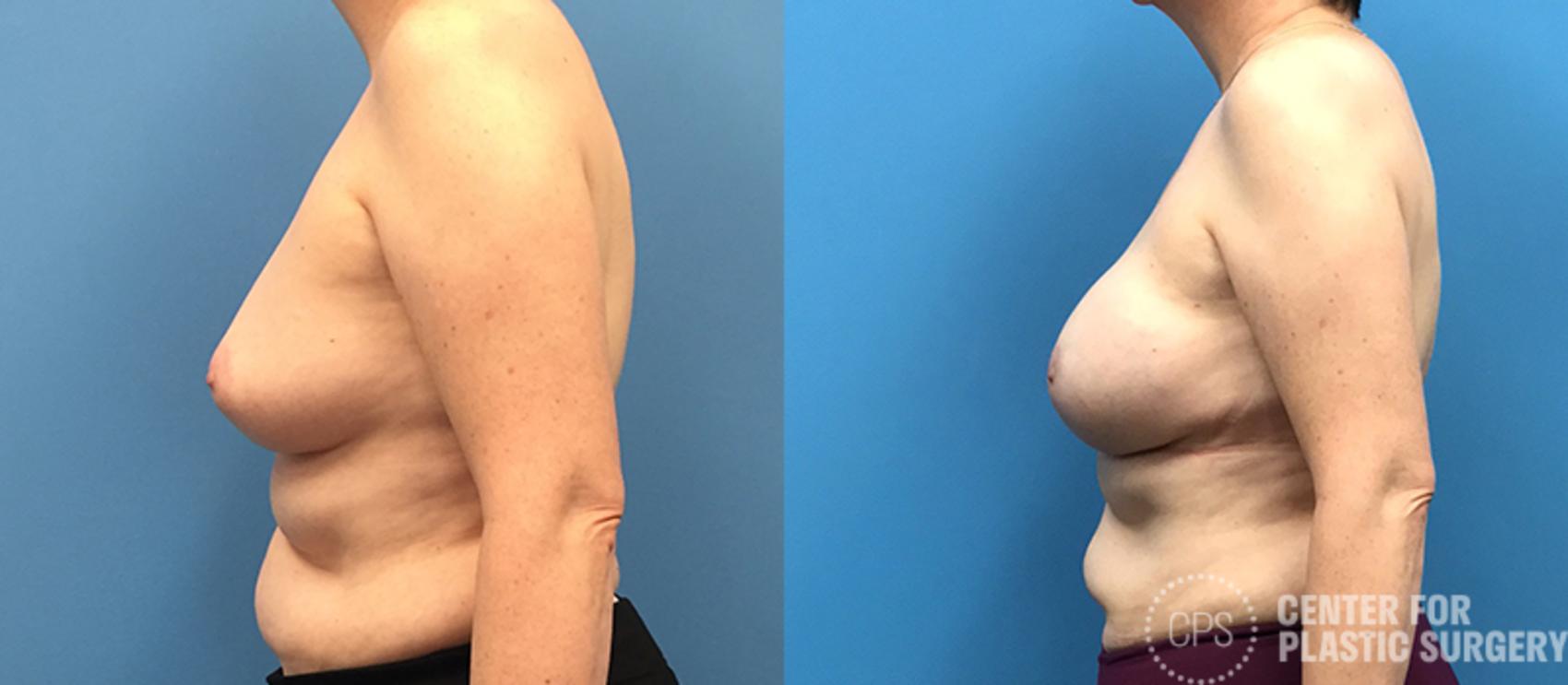 Breast Reconstruction Case 135 Before & After Left Side | Annandale, Washington D.C. Metropolitan Area | Center for Plastic Surgery