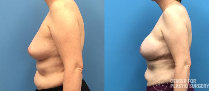 Breast Reconstruction Case 135 Before & After Left Side | Chevy Chase & Annandale, Washington D.C. Metropolitan Area | Center for Plastic Surgery