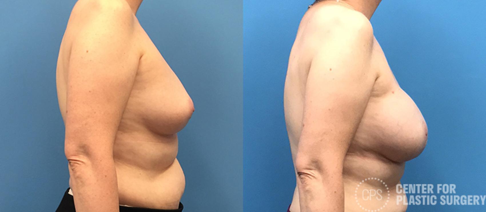 Breast Reconstruction Case 135 Before & After Right Side | Annandale, Washington D.C. Metropolitan Area | Center for Plastic Surgery