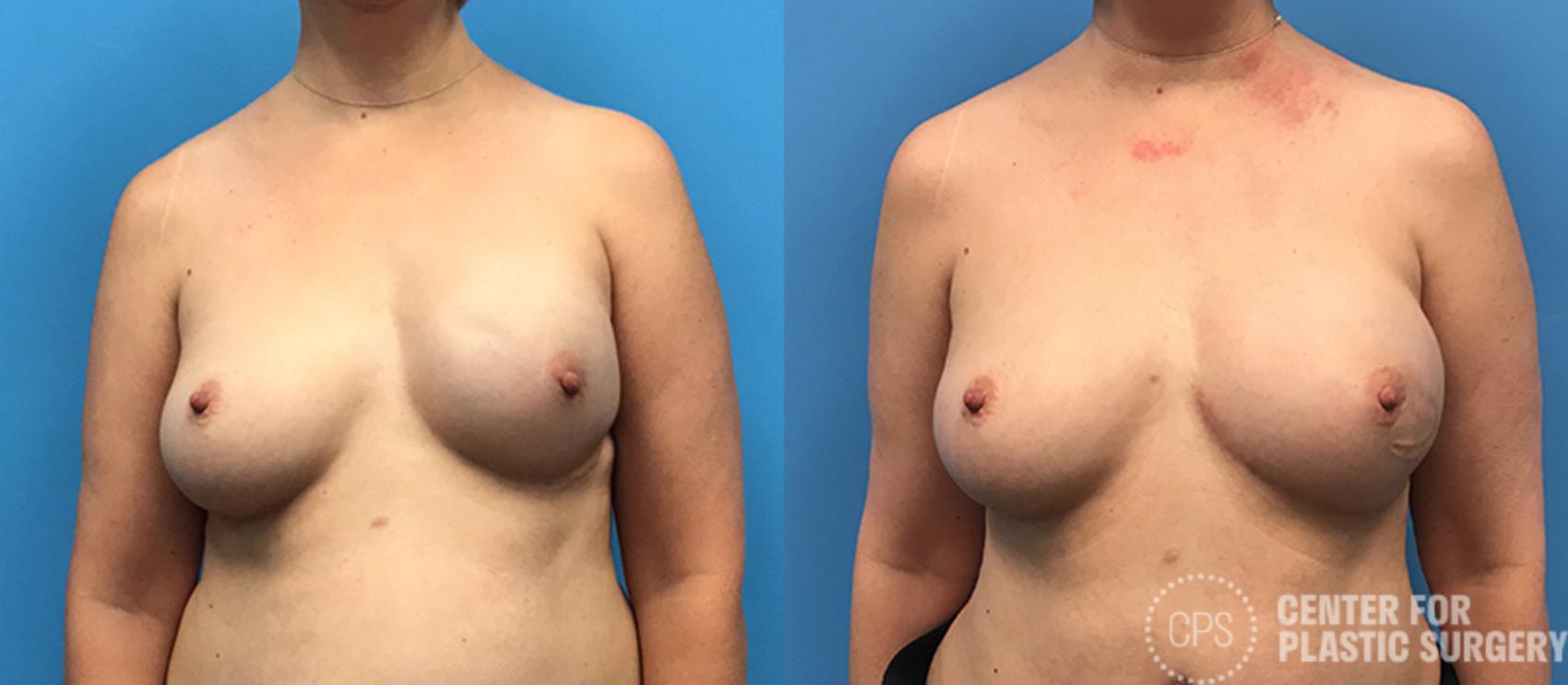 Breast Reconstruction Case 136 Before & After Front | Annandale, Washington D.C. Metropolitan Area | Center for Plastic Surgery