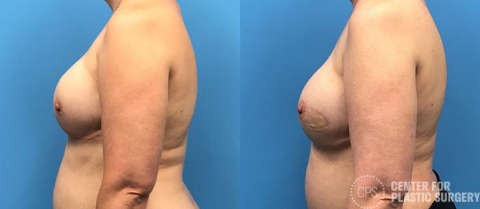 Breast Reconstruction Case 136 Before & After Left Side | Chevy Chase & Annandale, Washington D.C. Metropolitan Area | Center for Plastic Surgery