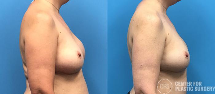 Breast Reconstruction Case 136 Before & After Right Side | Chevy Chase & Annandale, Washington D.C. Metropolitan Area | Center for Plastic Surgery