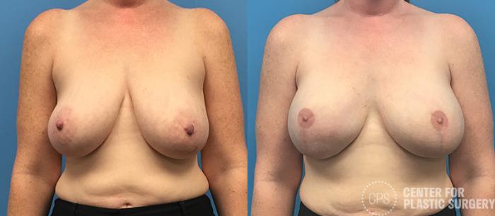 Breast Reconstruction Case 137 Before & After Front | Chevy Chase & Annandale, Washington D.C. Metropolitan Area | Center for Plastic Surgery