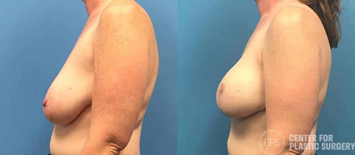Breast Reconstruction Case 137 Before & After Left Side | Chevy Chase & Annandale, Washington D.C. Metropolitan Area | Center for Plastic Surgery