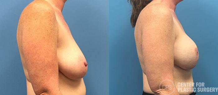 Breast Reconstruction Case 137 Before & After Right Side | Chevy Chase & Annandale, Washington D.C. Metropolitan Area | Center for Plastic Surgery