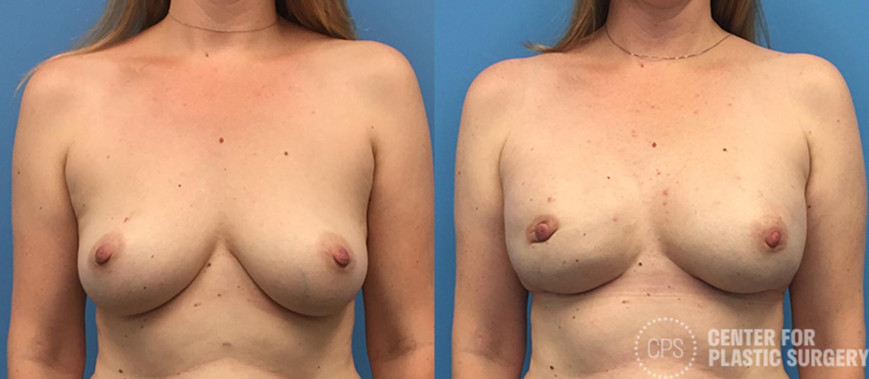 Breast Reconstruction Case 138 Before & After Front | Chevy Chase & Annandale, Washington D.C. Metropolitan Area | Center for Plastic Surgery