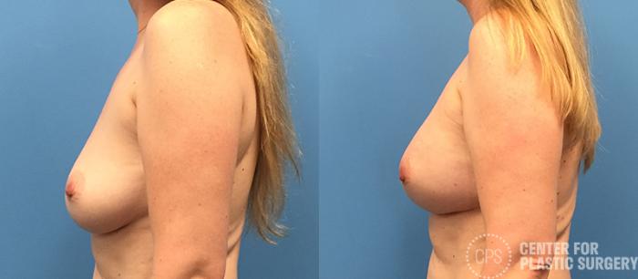Breast Reconstruction Case 138 Before & After Left Side | Chevy Chase & Annandale, Washington D.C. Metropolitan Area | Center for Plastic Surgery