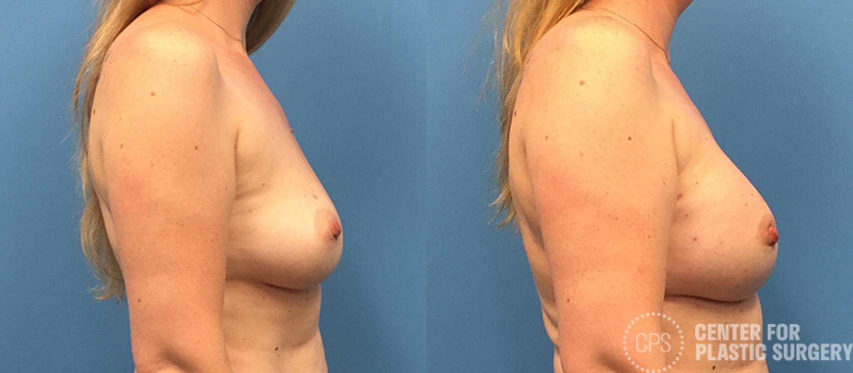 Breast Reconstruction Case 138 Before & After Right Side | Annandale, Washington D.C. Metropolitan Area | Center for Plastic Surgery